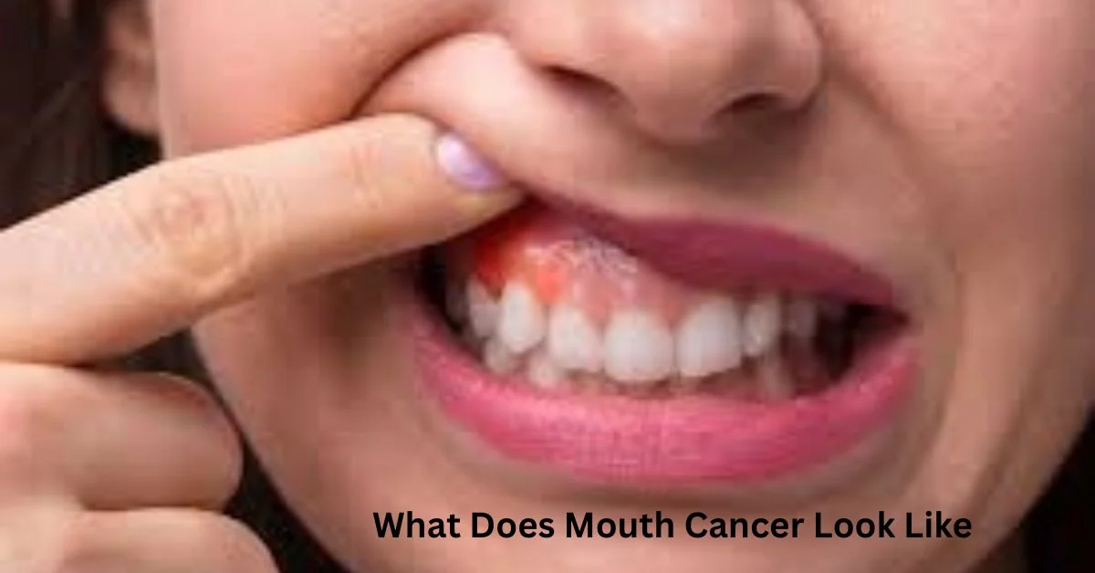 What Does Mouth Cancer Look Like